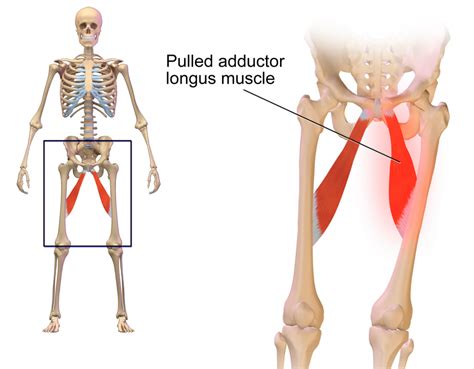 A Strained Groin Is Caused When One Of The Adductor Muscles Are Torn Or