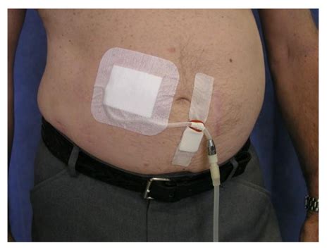 Abdominal Dialysis Catheter