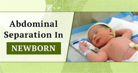 Abdominal Separation In Newborn Parenting Nation India