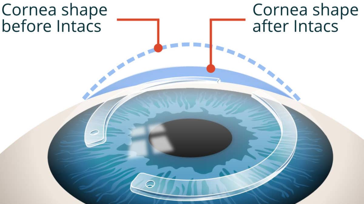 About Keratoconus The Eye Practice