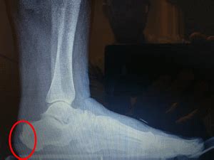 Achilles Bone Spur Surgery Recovery Time 6 8 Weeks Best Treatment