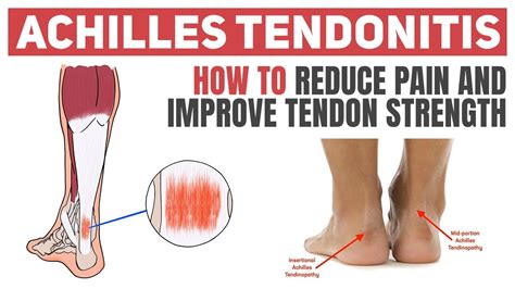 Achilles Tendon Rehab: Get Stronger Faster