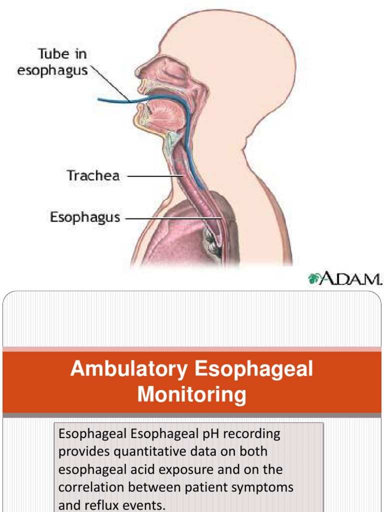 Ambulatory Reflux Monitoring Guides Proton Pump Inhibitor