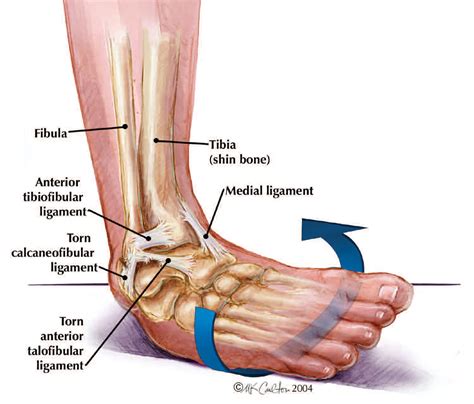 Anatomy Of An Ankle Sprain