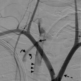 Angiogram Guide: Understanding Fatal Complications