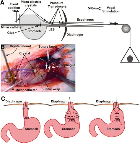 Antireflux Action Of Nissen Fundoplication And Stretch Sensitive