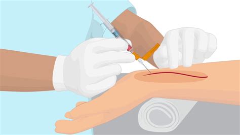 Arterial Blood Test Pain Relief