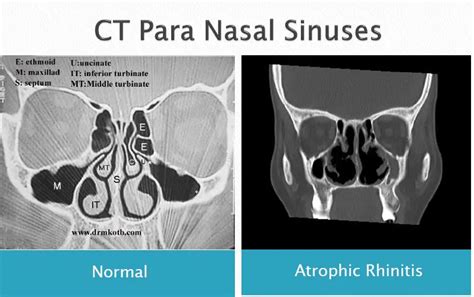 Atrophic Rhinitis Causes Symptoms And Treatment Options Doctor