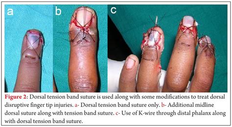 Avulsion Nail Bed