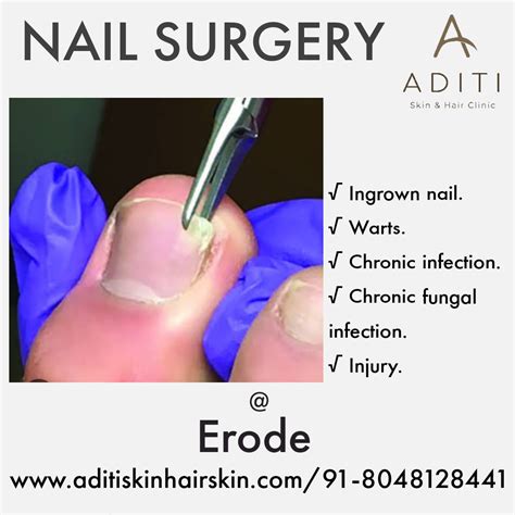 Avulsion Nail: Heal With Expert Care