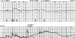 Baby B Bulletin Fetal Non Stress Test