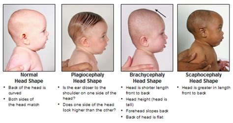 Baby Head Shape