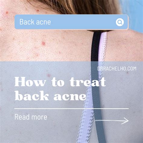 Back Acne Uptodate At Pa Smith Blog