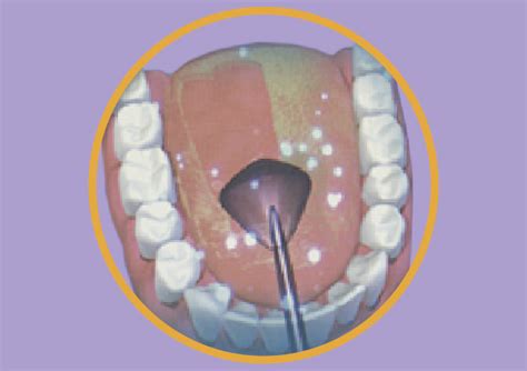 Bacteria Living On Your Tongue How To Get Rid Smile Store