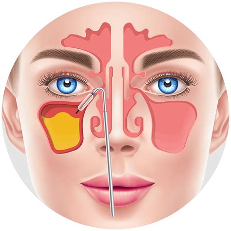 Balloon Sinuplasty For Snoring In Houston Kaplan Sinus Relief