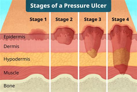 Bedsores Pressure Ulcers Treatments Stages Causes And Pictures