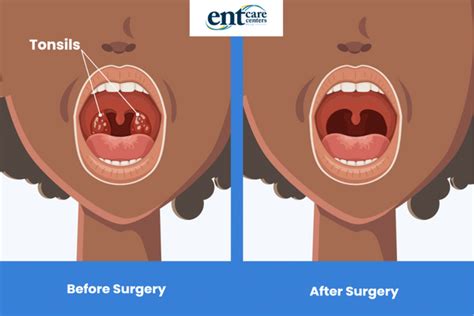 Before And After Tonsillectomy