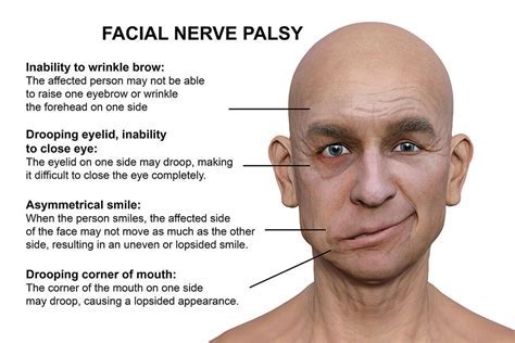 Bells Palsy Bradycardia