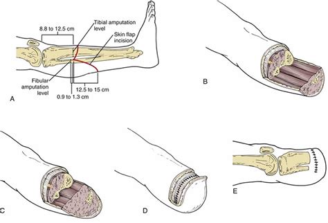 Below Knee Amputation