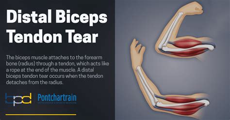 Bicep Tear Recovery Time