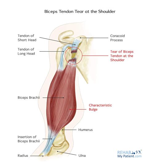 Bicep Tendon Tear Info Florida Muscle Tear Muscle Pain Tendon