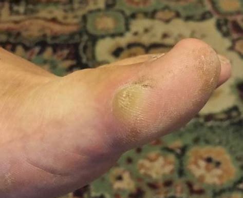 Big Callus On Side Of Foot Deals Emergencydentistry Com