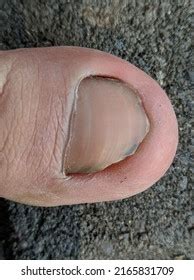 Big Toe Broken Nail Stock Photo 2165831709 Shutterstock