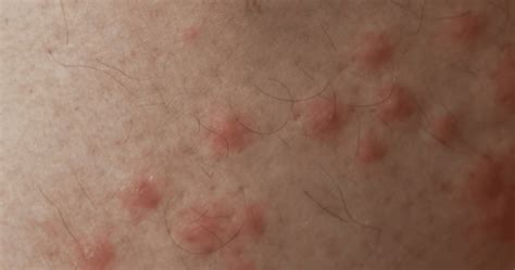 Biting Midge Bites: Soothe Itchy Skin Fast