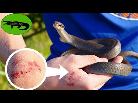 Black Racer Bites: Symptoms And Treatment