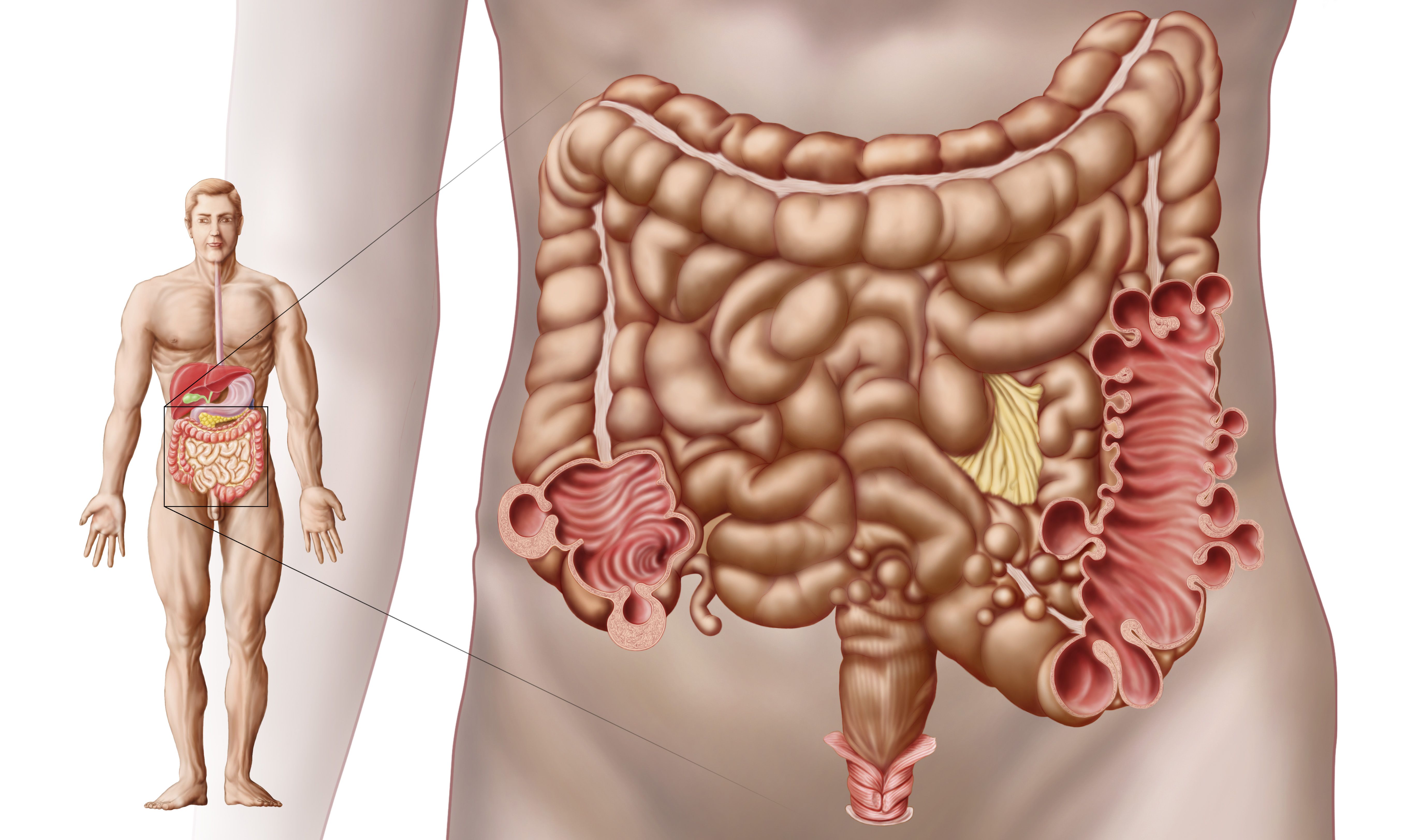 Bleeding From Diverticulitis