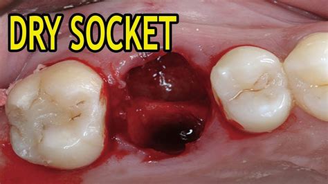 Blood Clot Tooth Socket