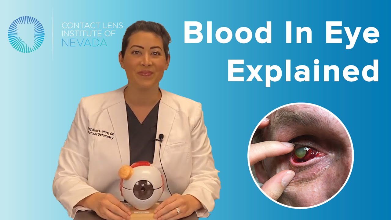 Blood In Eye Subconjunctival Hemorrhage Causes Amp Treatment