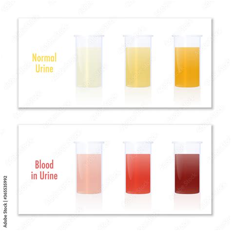 Blood In Urine Color