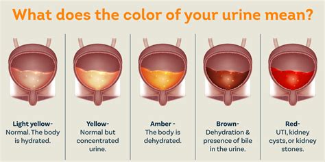 Blood In Urine Guide: Causes Explained