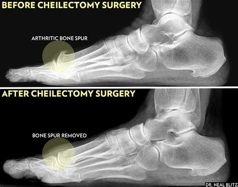 Bone Spur Removal