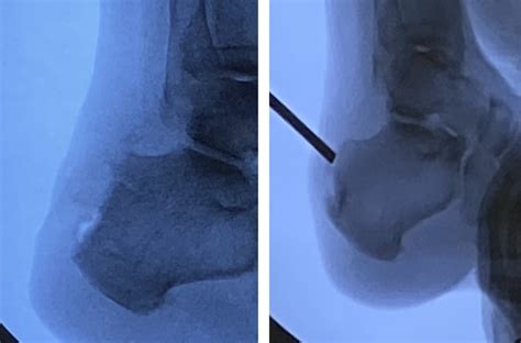 Bone Spur Surgery And Prevention Align Foot Ankle