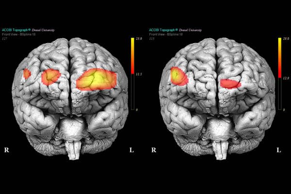 Borderline Personality Disorder Definition Causes Symptoms Types