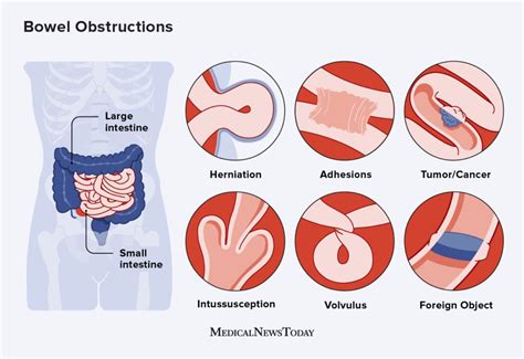 Bowel Obstruction Causes Management Teachmesurgery