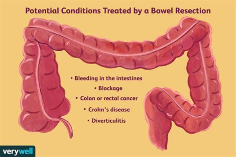 Bowel Resection Recovery