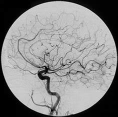 Brain Carotid Angiogram Imaging Glossary Patients Ur Medicine