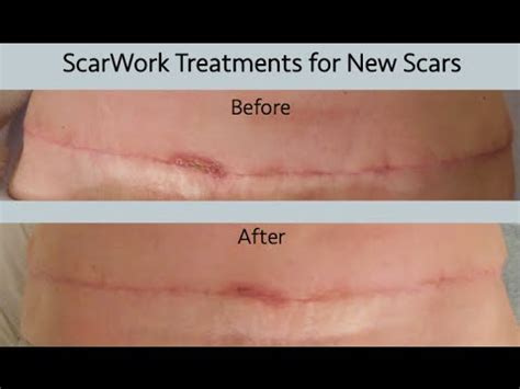 Breast Cancer Scar Therapy Using Scarwork And Scar Massage Youtube