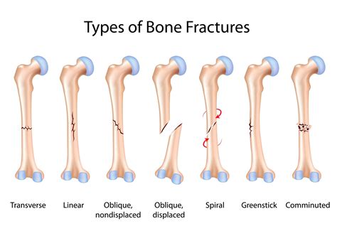 Broken Bones And Fractures