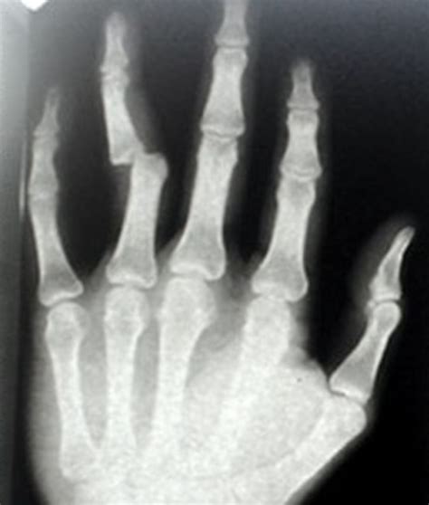 Broken Finger Symptoms Diagnosis Healing Time Treatment Hubpages