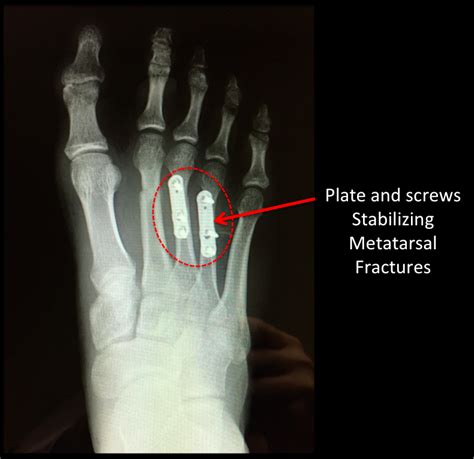 Broken Metatarsal: Recover In 68 Weeks Guaranteed