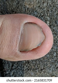 Broken Nail Toe