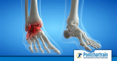 Broken Or Sprained Ankle Pontchartrain Orthopedics Sports Med