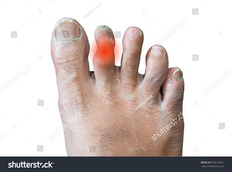 Broken Toe Showing Bruising On Skin Stock Photo 659516017 Shutterstock