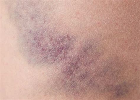 Bruise On Lower Back: Causes Revealed