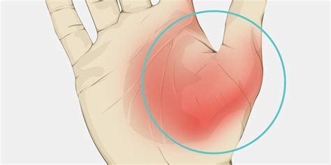 Bruise On Thumb: Healing Guide