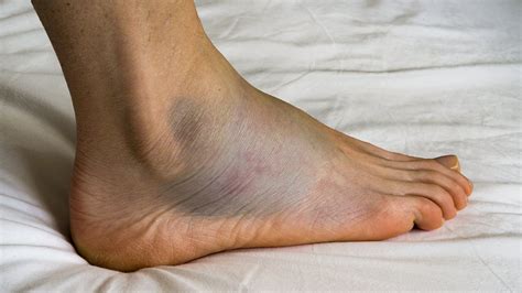 Bruise On Top Of Foot After Rolling Ankle Clearance